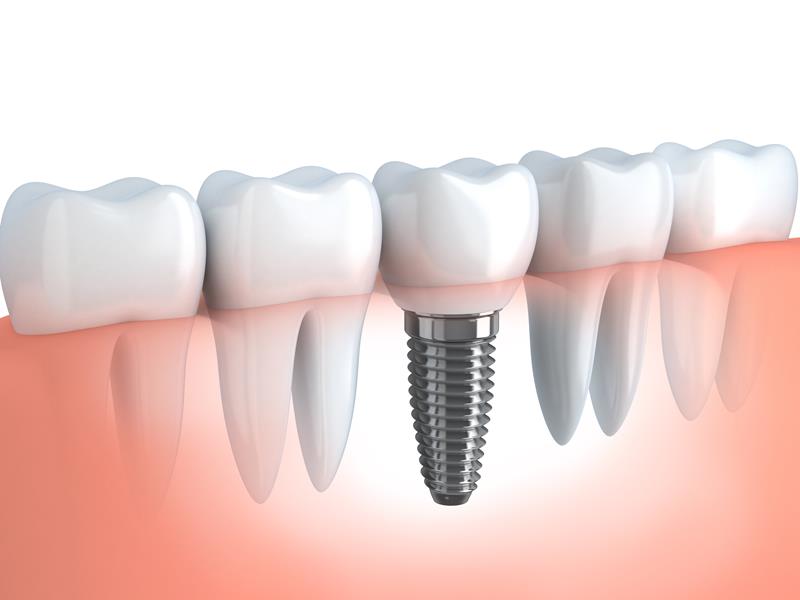 Dental Implants  Livermore, CA 