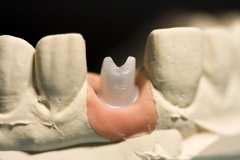 Implant Restoration  Livermore, CA 