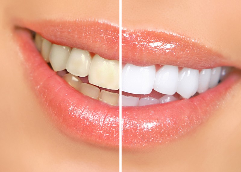 Teeth Whitening  Livermore, CA 