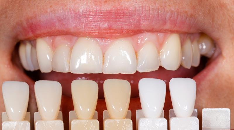 Veneers Livermore, CA